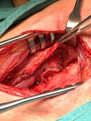 Resultado de diverticulectomia y miotomía de musculatura cricofaríngea y constrictor faríngeo mediante abordaje transcervical izquierdo.