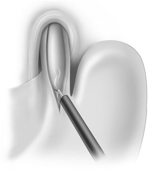 Technique for Heller’s myotomy.
