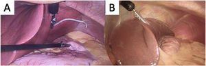 A) Use of silastic tubing and magnetic grasper; B) magnetic grasper applied directly to the left liver lobe.