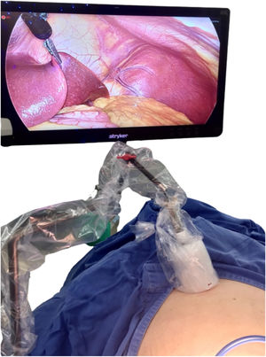 External view — position of the magnetic system using the articulated arm during surgery.