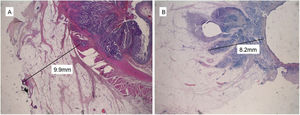 Optical microscope tumor measurements: (A) Circumferential resection margin distance in mm; (B) Depth of mesorectal infiltration in mm.