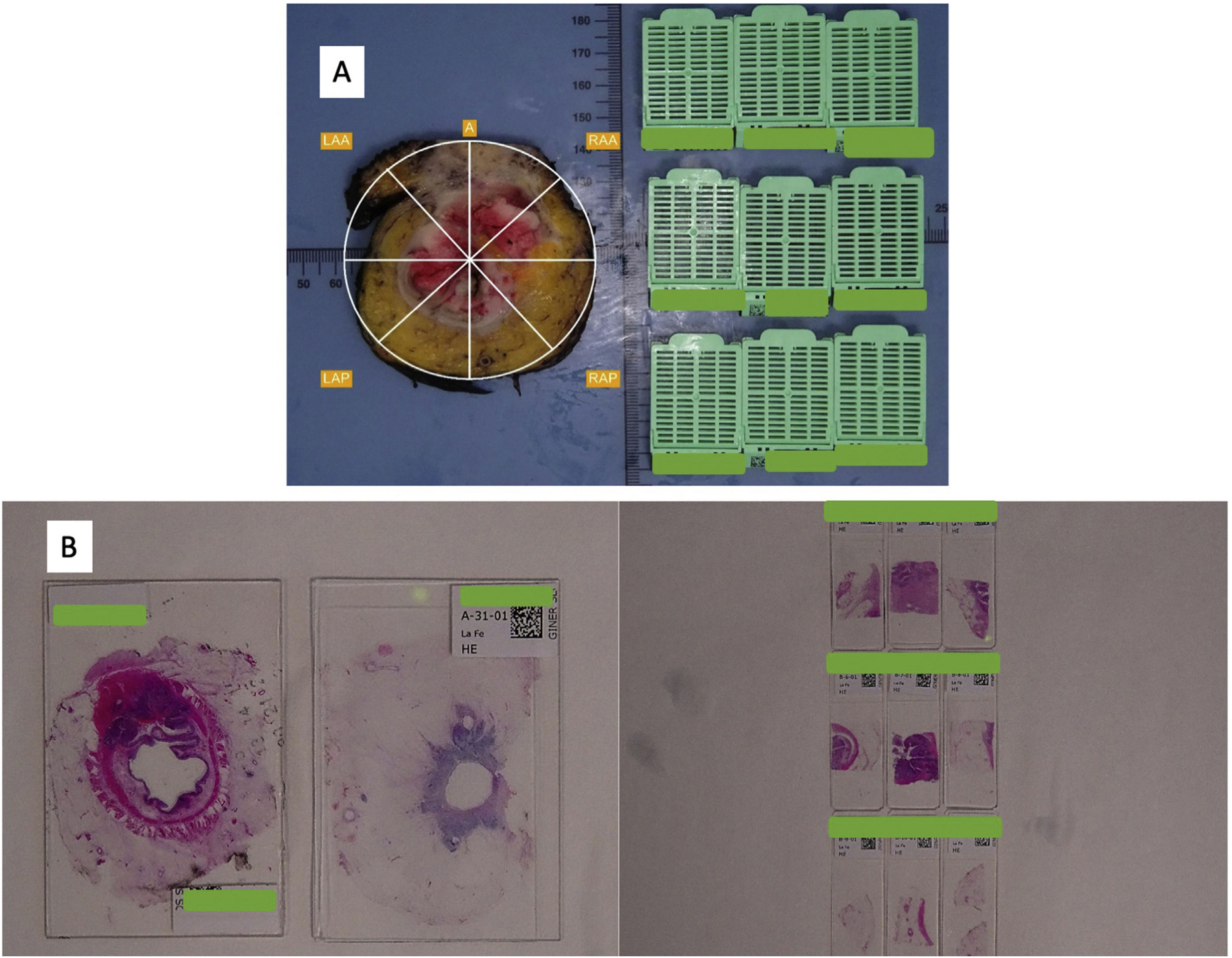 A comparison of whole-mount and conventional sections for pathological ...