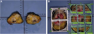 (A) Two “mirror” sections are selected to be included by both techniques (WM and SB) in a specimen with neoadjuvant treatment; (B) The comparison of both inclusion techniques (WM and SB) of 2 adjacent slices; A: anterior; LAA: left anterior; RAA: right anterior; LAP: left posterior; RAP: right posterior.