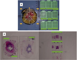 (A) The alternative inclusion by squares in radial sections. A: anterior; LAA: left anterior; RAA: right anterior; LAP: left posterior; RAP: right posterior; (B) Samples stained by H&E on macroblocks (left) and standard blocks (right).