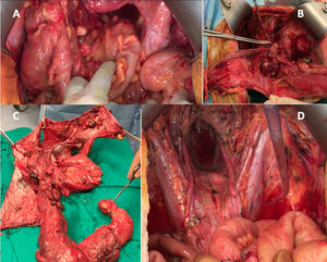 Imágenes de diferentes etapas de una cirugía citorreductora radical con procedimientos de peritonectomía (CRS) en un paciente con sarcomatosis peritoneal, incluido en la serie estudiada: A) Exposición de cavidad abdomino-pélvica, con sarcomatosis peritoneal; B) Cirugía citorreductora en bloque con realización de peritonectomía centrípeta en zona pélvica; C) Pieza quirúrgica extirpada tras la citorreducción radical del área pélvica (incluye peritoneo parietocólico bilateral y pélvico-vesical-fondo de saco de Douglas, útero, trompas, ovarios, recto-sigma, colon descendente, colon transverso y anastomosis ileocólica previa), y D) Pelvis con citorreducción completa (CC0).