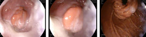 Endoscopia digestiva alta en la que se aprecia prolapso de la mucosa gástrica en el esófago distal.
