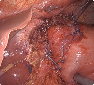 Imagen laparoscópica del refuerzo de la funduplicatura tipo Nissen y la gastropexia de Hill.