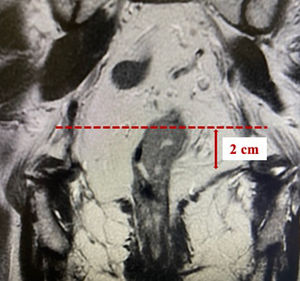 Vista coronal potenciada en T2 de resonancia magnética (RM) que muestra un tumor rectal y su relación con el aparato esfinteriano y músculo puborrectal (línea de puntos roja). Los tumores que sean incluidos en el estudio deben tener una extensión no superior a 3 cm y su límite inferior no debe superar la línea discontinua que se muestra en la figura.