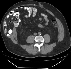 TC que muestra la hernia intraparietal con disrupción de la línea semilunar.