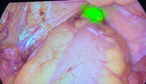 Transiluminación del rectoscopio con luz a través de la pared rectal. El aumento de la visibilidad que confiere el uso del modo flourescencia en la cámara de laparoscopia hace innecesario disminuir la fuente de luz de la laparoscopia para poder objetivar la luz del rectoscopio.