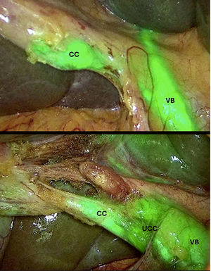 Visión de la VB, CC y la UCC con ICG antes (arriba) y después (abajo) de la disección del triángulo de Calot. CC: conducto cístico; ICG: indocyanine green; UCC: unión cisticocoledocal; VB: vía biliar.