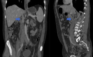 TAC: agenesia renal derecha y ausencia de vena cava inferior (VCI) subhepática e intrahepática. VCI infrahepatica dilatada y con trombosis que se extiende hasta ambas venas iliacas y femorales.