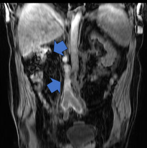 RMI: trombosis a nivel de eje ilio-cavo. Agenesia renal derecha y ausencia VCI intrahepática.