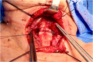 Cervicotomy. End-to-end tracheal anastomosis following resection of the stenosis.