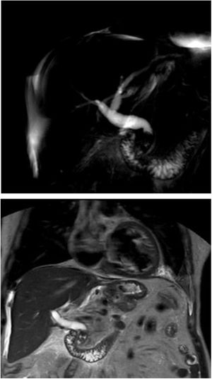 Cortes coronales de CRMN detectan coledocolitiasis distales que condicionan moderada dilatación de vía biliar extrahepática.