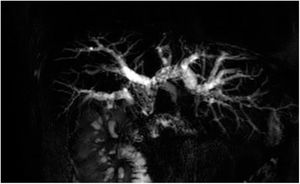 CRMN muestra hepatolitiasis múltiple bilateral secundaria a estenosis de la anastomosis hepatoyeyunal.