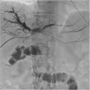 La colangiografía confirma estenosis a nivel de la anastomosis hepatoyeyunal; se procede a dilatación con balón de angioplastia.