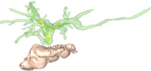 Reconstrucción 3D de la anatomía mediante software especializado (Mimics Innovation Suite, Materialise). Se visualizan abundantes hepatolitiasis bilaterales, a nivel de radicales biliares derechos e izquierdo, así como variante anatómica con drenaje independiente del radical biliar posterior derecho.
