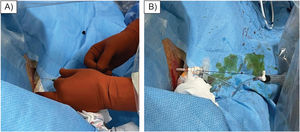 A) Punción para acceso biliar derecho percutáneo. B) Colocación de introductor de 12 Fr, como puerto para posterior introducción del colangioscopio flexible.