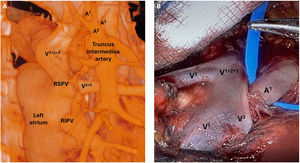 A) Posterior view of the 3D reconstruction. RSPV: right superior pulmonary vein. RIPV: right inferior pulmonary vein. B) Intraoperative view of the operative field.