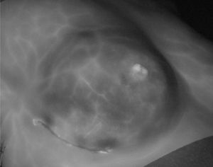 Áreas de falsa necrosis. Esta paciente con mastectomía preservadora de piel-pezón e implante prepectoral presenta una hipoperfusión falsa de la piel por un colgajo cutáneo fino. Se observan los vasos del plexo subdérmico que garantizan una perfusión adecuada del colgajo.