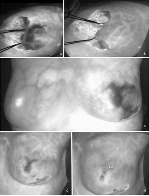 Isquemia precoz con recuperación tardía. a) Mujer con una mamoplastia reductora extrema que presenta hipoperfusión distal en el colgajo lateral a los 30 segundos del bolo de VIC. B) A los 140 segundos se observa la recuperación de la perfusión en dicha área. c) Paciente con una mastectomía preservadora de piel y pezón izquierda que presenta área extensa de isquemia en polos superior e inferior de la mama que se recupera a los dos minutos del bolo de VIC (d, e).