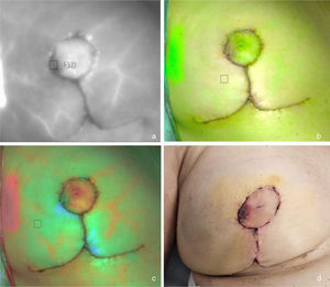 Isquemia en área lateral de areola derecha. La angiografía con VIC identifica un área de sufrimiento vascular en la periferia lateral de la areola derecha visible en el modo de fluorescencia (ausencia de contraste [a]), de superposición (ausencia de verde [b]) y de fluorescencia segmentada por color (ausencia de rojo [c]). Durante el posoperatorio la paciente sufrió una epidermiólisis superficial en dicha área que no precisó intervención quirúrgica (d).