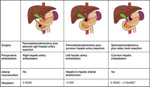 Treatment scheme. Hepatic arterial embolization before pancreatic surgery with arterial resection allows pancreatectomy to be carried out without synchronic liver resection. PDAC, pancreatic ductal adenocarcinoma. CHC, cholangiocarcinoma. PNET, pancreatic neuroendocrine tumor. LHA, left hepatic artery. RHA, right hepatic artery. LGA, left gastric artery. RGA, right gastric artery. SA, splenic artery. GEA, gastroepiploic artery.