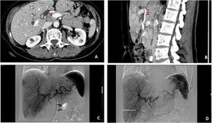 67-year-old woman with distal cholangiocarcinoma: Preoperative coil embolization of the left and middle hepatic artery. A. Preoperative axial contrast-enhanced CT image (portal phase) showing tumoral contact with the posterior aspect of the proper hepatic artery (arrow). B. Preoperative sagittal contrast-enhanced CT image (pancreatic phase) demonstrates tumoral contact with the posterior aspect of the proper hepatic artery (*) next to the origin of the left hepatic artery (arrows). C. Digital subtraction angiography (DSA) of the celiac artery prior to left hepatic artery embolization. D. DSA of the celiac trunk after selective microcoil embolization of the 2 left hepatic arteries.