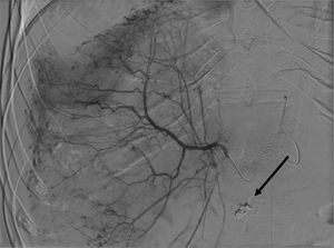Arteriografía selectiva del tronco celiaco. Se evidencian 2 puntos de extravasación de contraste dependientes de la rama derecha accesoria, se embolizan (flecha negra). La arteriografía de control muestra incontables focos de sangrado subcapsulares.