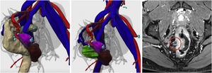 3D reconstruction of rectal adenocarcinoma.