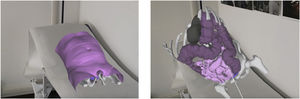 Hologram visualization for preoperative planning.
