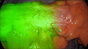 AF-ICG en hemicolectomia izquierda. (Modo SPY Overlay – Stryker 1688®).