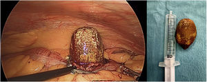 Extracted gallstone. Diagnosis: Gallstone ileus of the colon.