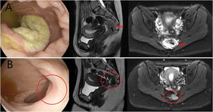 Caso 1. A) colonoscopia, RM sagital y RM difusión al diagnóstico (flecha señalando el tumor). B) rectoscopia, RM sagital y RM difusión axial a los 6 meses del tratamiento (círculo remarcando la respuesta clínica completa).