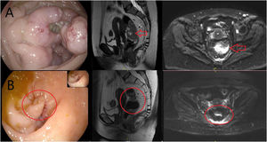 Caso 2. A) colonoscopia, RM sagital y RM difusión al diagnóstico (flecha señalando el tumor). B) rectoscopia con estenosis residual y RM sagital, y difusión con respuesta tras el fin de la inmunoterapia (círculo remarcando la estenosis en colonoscopia y la ausencia de tumor en la RM).