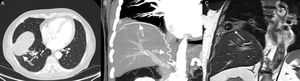 Tomografía axial computarizada. Se aprecia lesión nodular hipodensa de aspecto quístico en lóbulo inferior derecho asociado a componente atelectásico. Aumento de vascularización dependiente de las arterias pulmonar y diafragmática derechas (A). Se visualiza la arteria diafragmática inferior derecha que se embolizó previamente a la cirugía (B). Resonancia magnética nuclear. Secuencia T2, se aprecia lesión hipointensa en lóbulo inferior derecho (C).