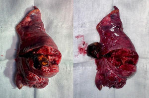 Cuña pulmonar de 10,8x6,3x3,2cm, en cuyo interior se aprecia una formación independiente de consistencia pétrea, redondeada, de color marrón verdoso sugestivo de cálculo biliar.