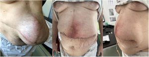 A) Eventración magna preoperatoria. B y C) Resultado tras eventroplastia.