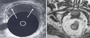 Imagen de ecografía endorrectal y resonancia magnética de un tumor cT1.