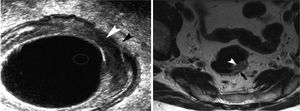 Imagen de ecografía enorrectal y resonancia magnética de un tumor cT2. Las flechas muestran la muscularis propia.