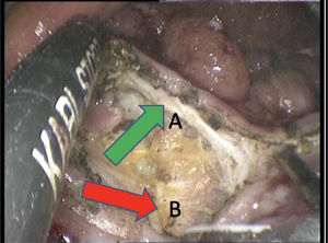 Resección de pared completa. Mediante el bisturí ultrasónico se secciona la pared del recto hasta la grasa perirrectal. Se continúa en este plano justo por debajo de la capa muscular (flecha A), no introduciéndose en el interior de la grasa perirrectal (fecha B).