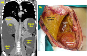 Imágenes de un paciente con PAB por EQH complicada, rota a peritoneo. A)Tomografía computarizada. B)Laparotomía enJ (se aprecia el peritoneo parietal y visceral impregnado de un capa de fibrina y bilis).