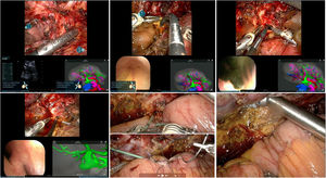 Hepaticoyeyunostomía en Y de Roux para estenosis de la vía biliar. Descripción detallada paso a paso (de izquierda a derecha) de la identificación del conducto biliar dilatado, apertura del conducto biliar e identificación de la estenosis, extracción de múltiples litiasis, verificación colangioscópica de la ausencia de litiasis en ambos conductos hepáticos principales, colocación del tutor transanastomótico y resultado final de la hepaticoyeyunostomía.