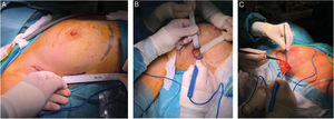 Incisión de 4,5-5cm en el borde externo de la mama en su parte media y a la altura de la línea axilar anterior (A). Disección por plano subcutáneo en toda la circunferencia de la incisión (B y C).