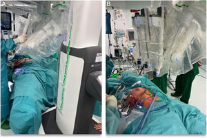 Colocación del robot entre las piernas de la paciente (A), con el despliegue de los brazos hacia la mama que se va a operar (B).