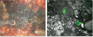 Visualización intraoperatoria del azul de metileno inyectado previamente para los límites del CAP y tejido retroareolar (A). Visualización del verde de indocianina para el límite medial de la mama (B).