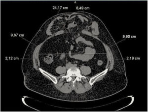 Imagen de TC de abdomen de eventración R M2-3 W2, donde se indican las mediciones realizadas: longitud y grosor de la pared lateral del abdomen, diámetro transverso del abdomen y diámetro transverso del defecto herniario.