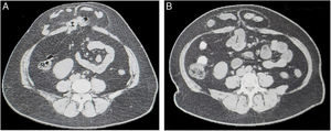 TC de abdomen correspondiente al mismo paciente, donde pueden apreciarse los cambios morfológicos secundarios al tratamiento con TB. A: pretratamiento con TB. B: postratamiento con TB.