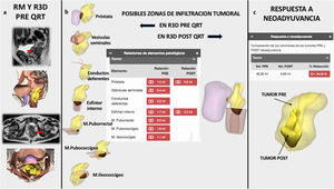 Imágenes del planificador quirúrgico 3D a partir de la RM pre y post-neoadyuvancia. a)Corte sagital y axial de la RM pre neoadyuvancia. Flecha roja: posibles zonas de infiltración tumoral e imágenes del planificador 3D correspondientes a los mismos cortes sagital y axial. Estructura en amarillo: tumor. b)Posibles estructuras infiltradas valoradas mediante algoritmos matemáticos de la reconstrucción 3D a partir de la RM pre y la post-neoadyuvancia. Estructura en amarillo: tumor; estructura en rojo: posibles zonas de infiltración. c)Valoración matemática de la regresión tumoral post-neoadyuvancia.